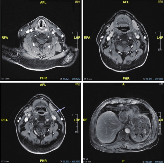 图4 喉MRI及腹部MRI（6疗程后）.jpg